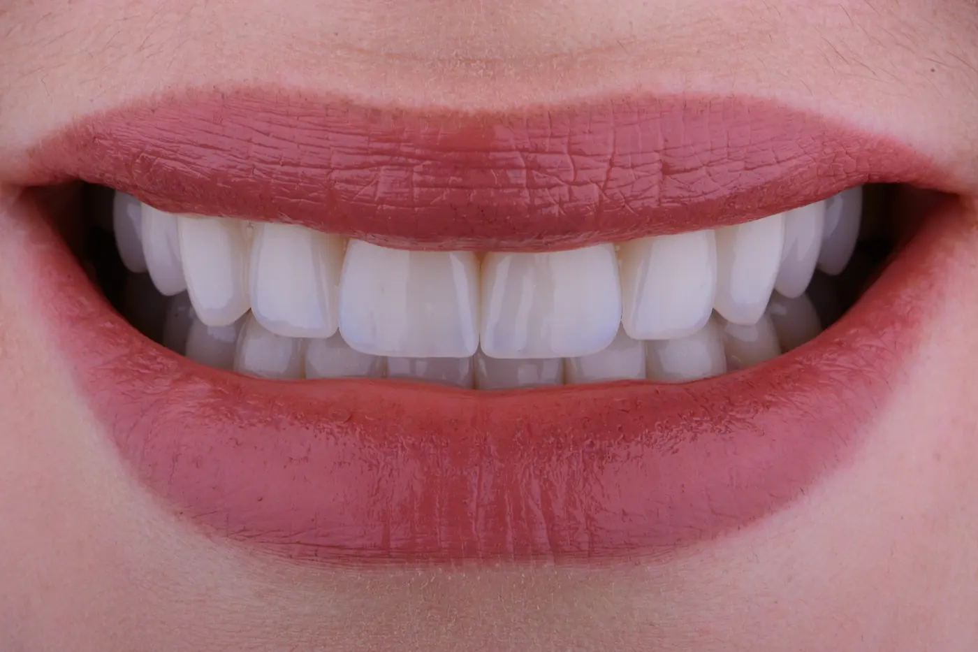 Close-up of a smile after porcelain veneers